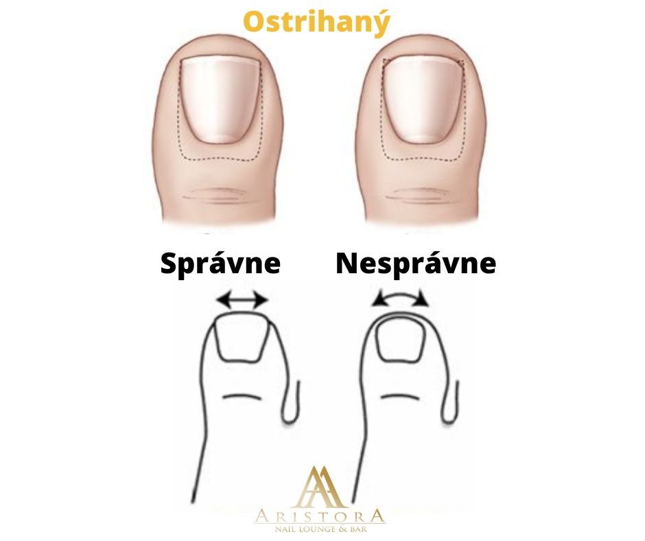 Špony – bezbolestné riešenie zarastajúcich nechtov | AristorA